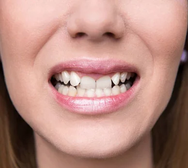 Five Benefits of Invisible Clear Aligners Over Metal Braces